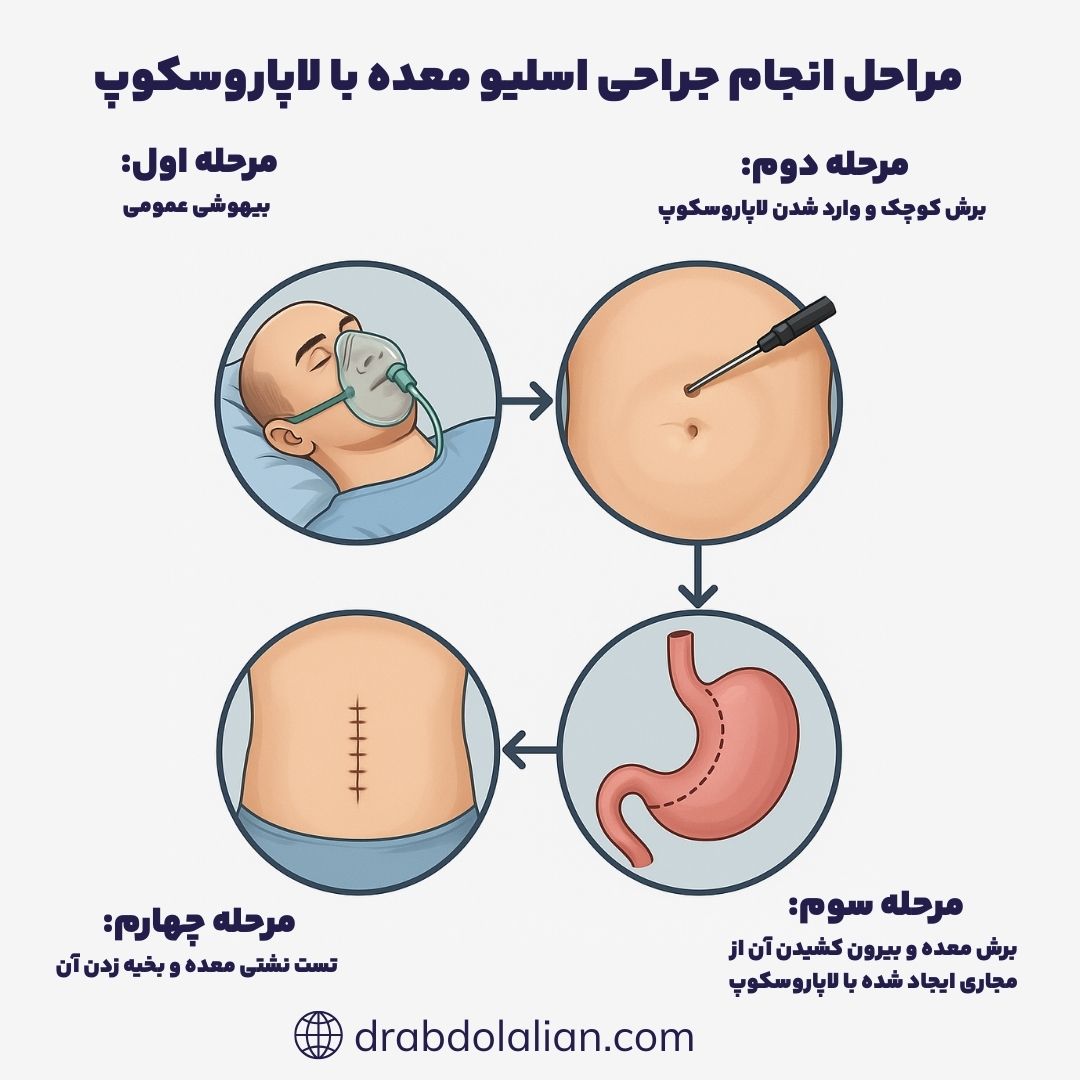 مراحل انجام اسلیو معده