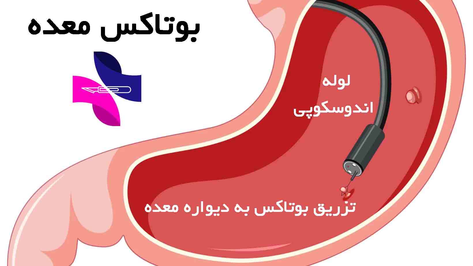 نحوه انجام بوتاکس معده